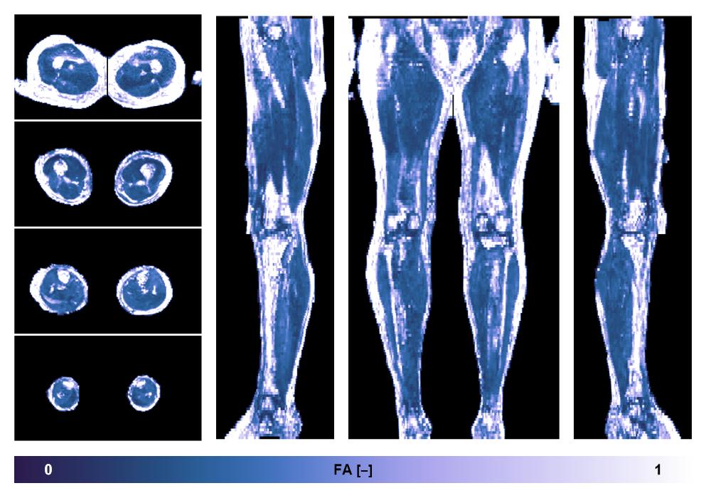 IVIM corrected whole leg muscle fractional anisotropy obtained from diffusion tensor imaging.